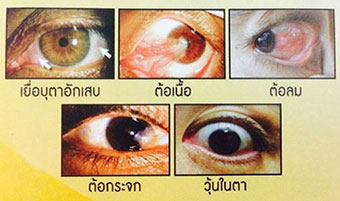 Bim O eye care บิม โอ แคปซูล ดูแลสุขภาพตา ความผิดปกติของดวงตา วุ้นตาเสื่อม เนื้อเยื่อตาเสื่อม